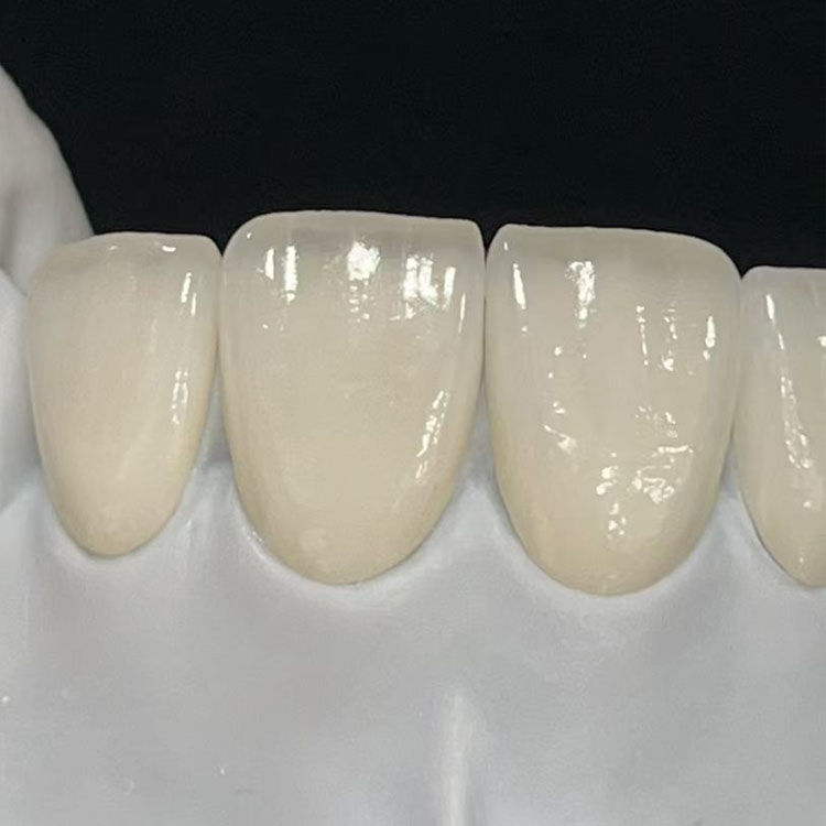 emax dental 4