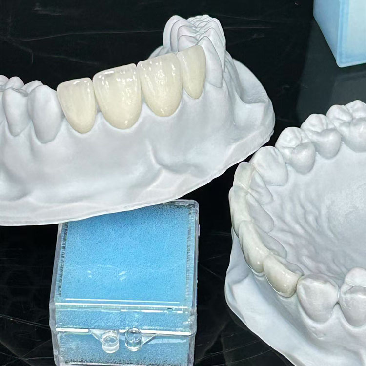 emax dental 5